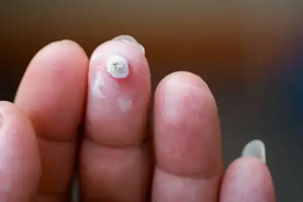 Image of white wart before cryopen treatment West Hampstead