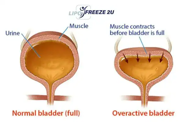 diagram of overactive bladder treatment West Hampstead