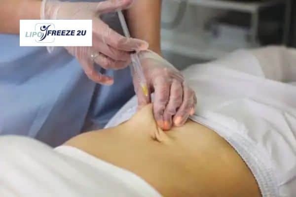 How Does Aqualyx Fat Dissolving Injection Work to Break Down Fat West Hampstead?