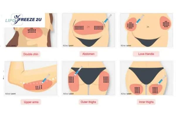 Benefits of Choosing Aqualyx for Fat Reduction West Hampstead