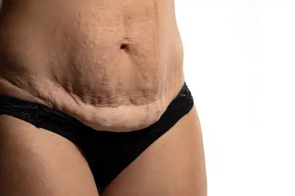 loose skin after weight loss injections West Hampstead