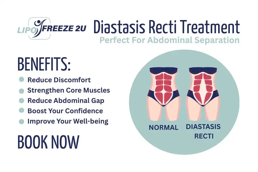 How Long Will It Take to See Improvements in Diastasis Recti West Hampstead