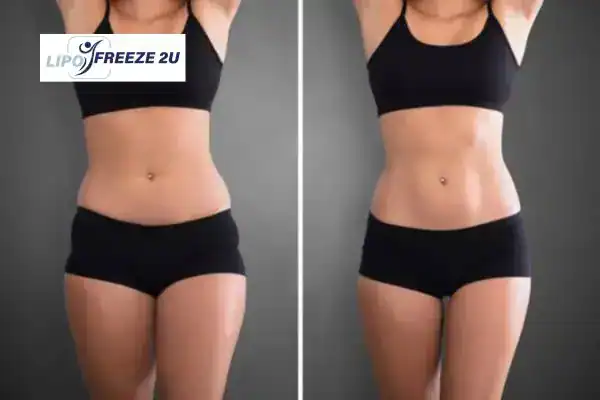 How Can LIPO FREEZE 2U Support Your Post-Pregnancy Body Recovery West Hampstead?