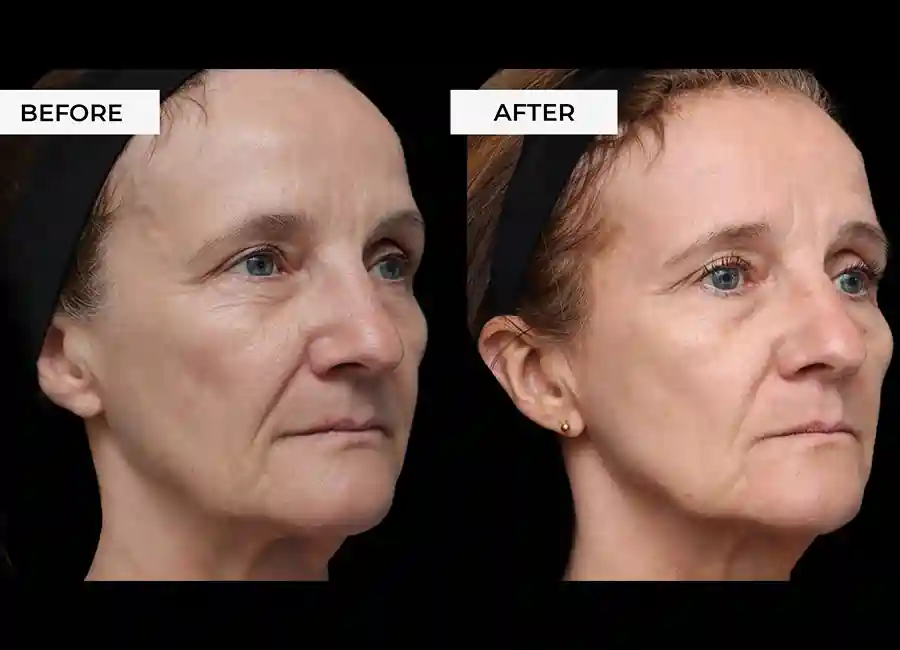 How Many RF Microneedling Sessions Will You Need to See a Difference West Hampstead?