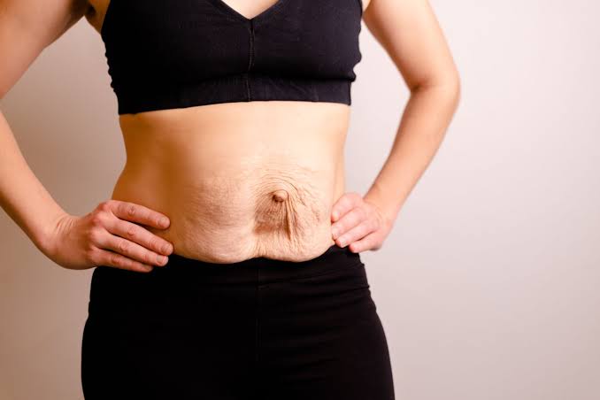 Is Surgery Really the Only Way to Repair Diastasis Recti West Hampstead?