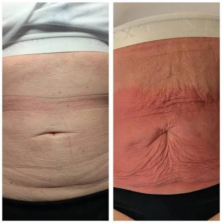 How Does RF Microneedling Improve Crepey, Thin and Uneven Skin Texture West Hampstead?