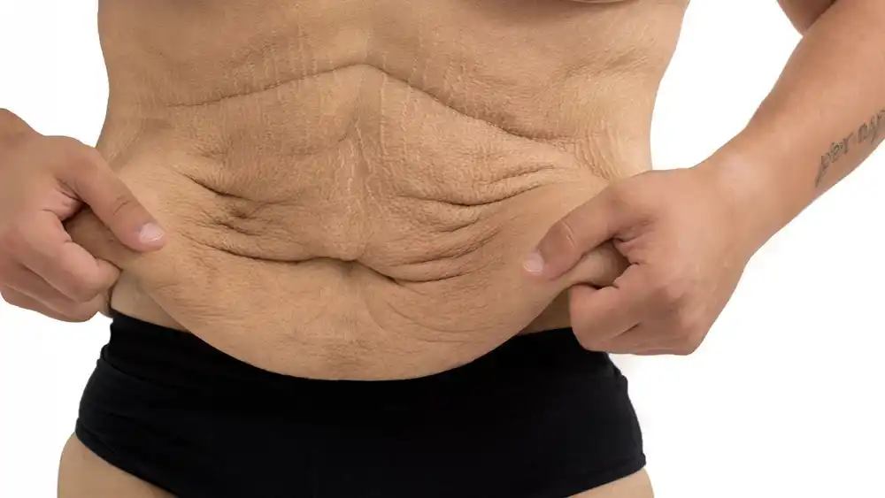 RF Microneedling for Loose Skin: How Can It Help Tighten and Reshape the Skin West Hampstead?
